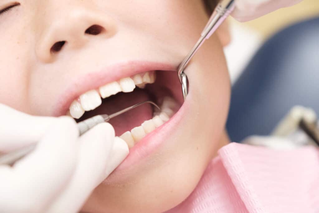歯科検診を受ける子供：探針で虫歯を探す