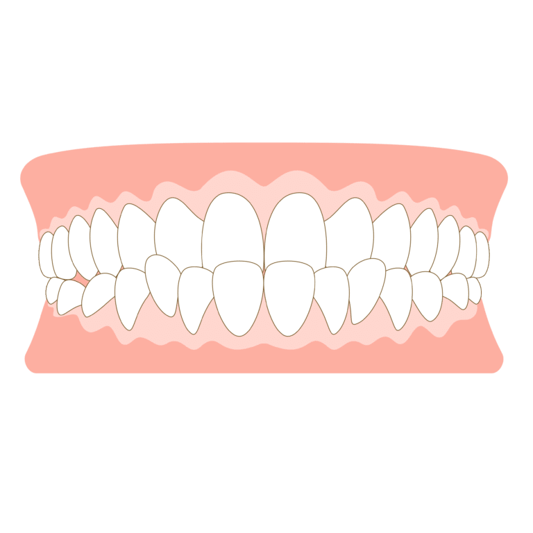 反対咬合_受け口_クロスバイト_交叉咬合_切端咬合