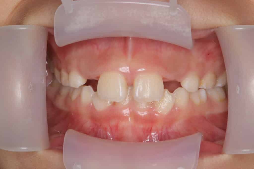 叢生:治療前(7歳1か月)