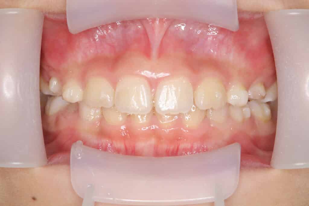 叢生:治療後(1年9か月経過)