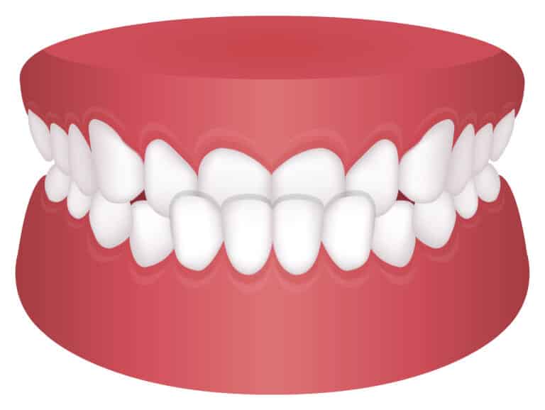 反対咬合_受け口_Teeth trouble ( bite type ) vector illustration /Underbite