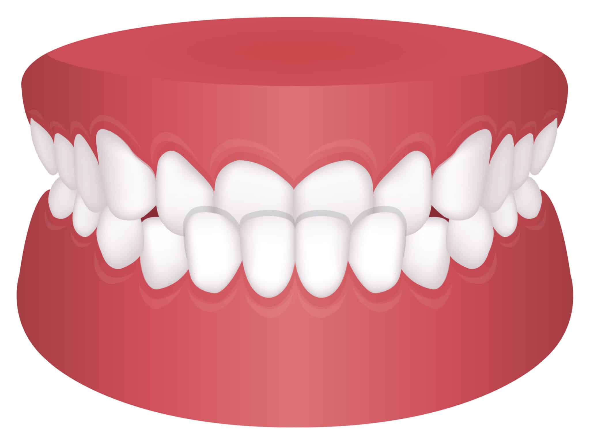 反対咬合_受け口_Teeth trouble ( bite type ) vector illustration /Underbite
