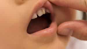 子供の歯　癒合歯