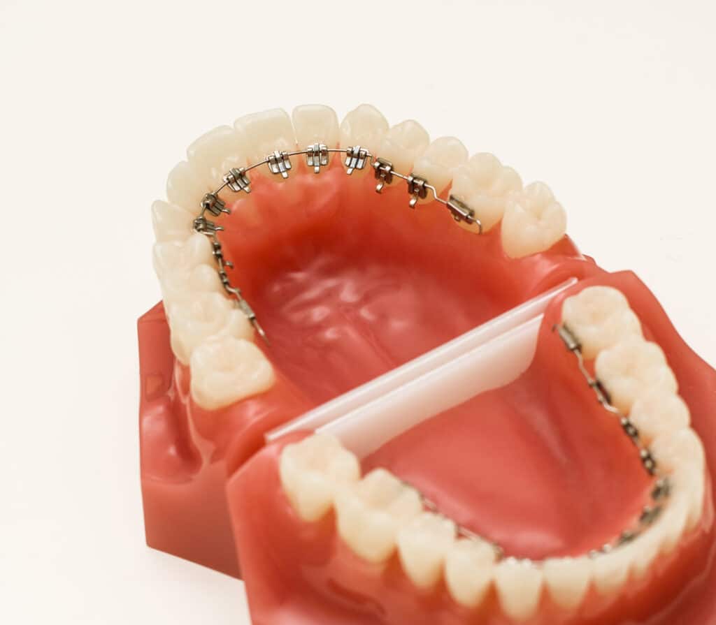 Dentist demonstration teeth model of orthodontic bracket