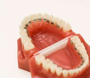 Dentist demonstration teeth model of orthodontic bracket