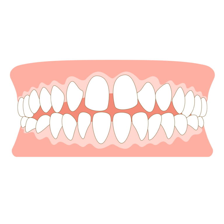 すきっ歯の歯並び