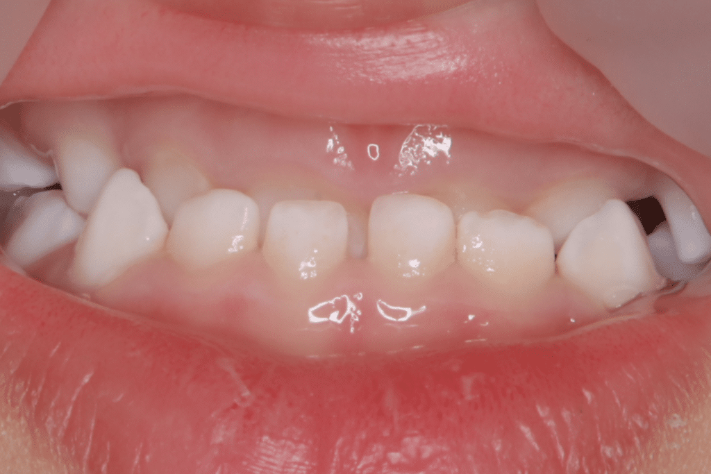 反対咬合(2歳11ヶ月)開始後5ヶ月