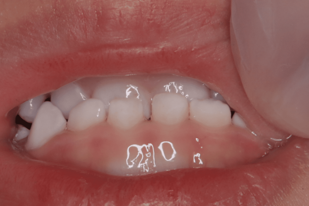 反対咬合(3歳0ヶ月)開始後6ヶ月