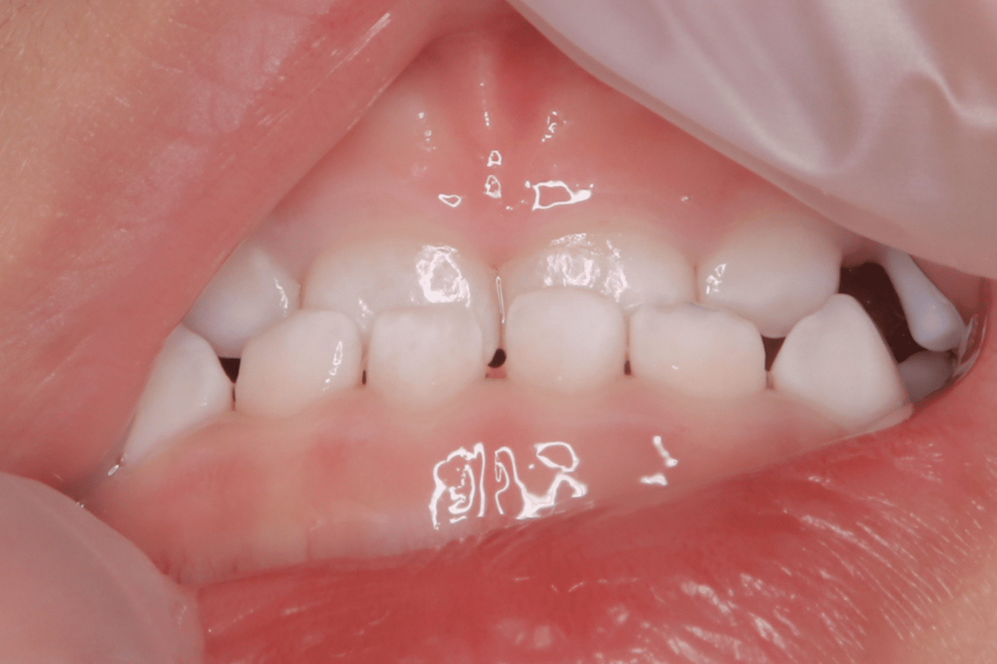 反対咬合（受け口）の症例｜2歳6ヶ月から開始｜マウスピース＋筋
