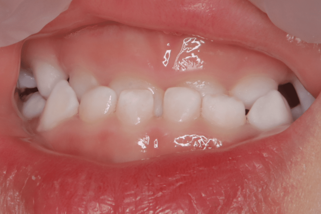 反対咬合(3歳1ヶ月)開始後7ヶ月