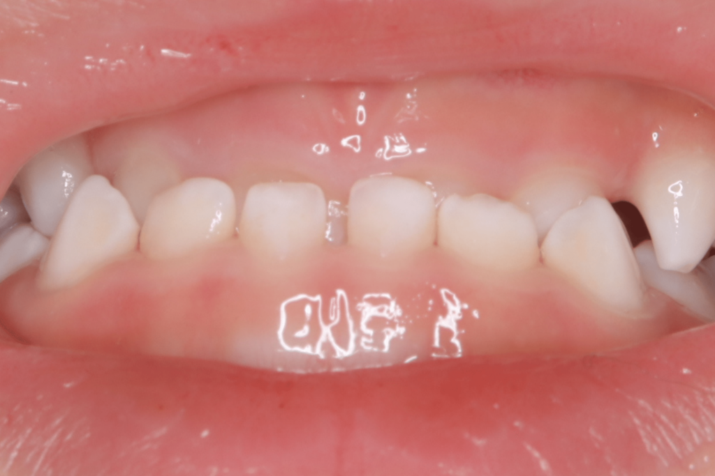 反対咬合(3歳2ヶ月)開始後8ヶ月