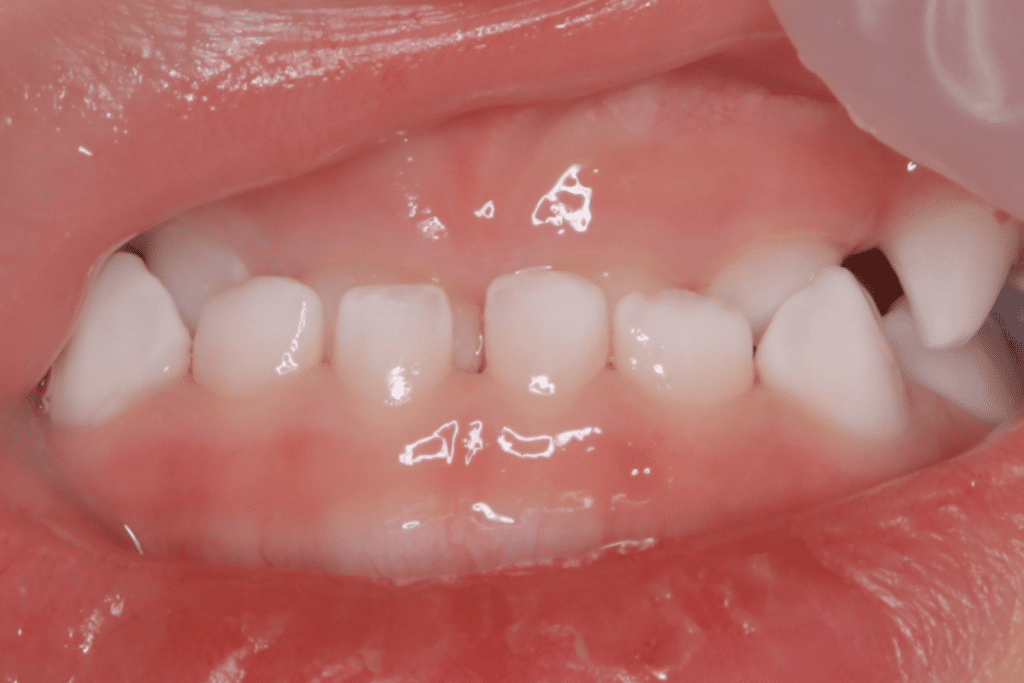 反対咬合(3歳3ヶ月)開始後9ヶ月