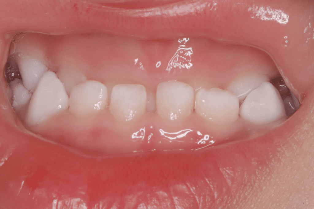 反対咬合(3歳4ヶ月)開始後10ヶ月