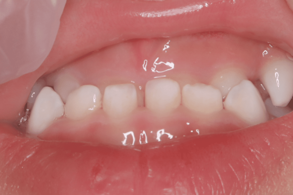 反対咬合(3歳5ヶ月)開始後11ヶ月