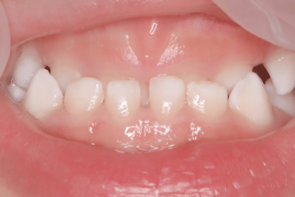 反対咬合(3歳6ヶ月)開始後1年