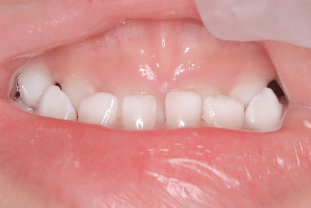 反対咬合(3歳7ヶ月)開始後1年1ヶ月