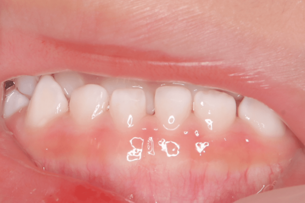 反対咬合(3歳8ヶ月)開始後1年2ヶ月