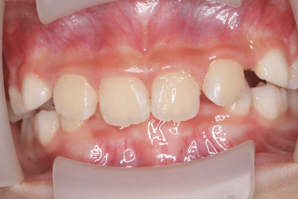 過蓋咬合(9歳4ヶ月)開始後2ヶ月