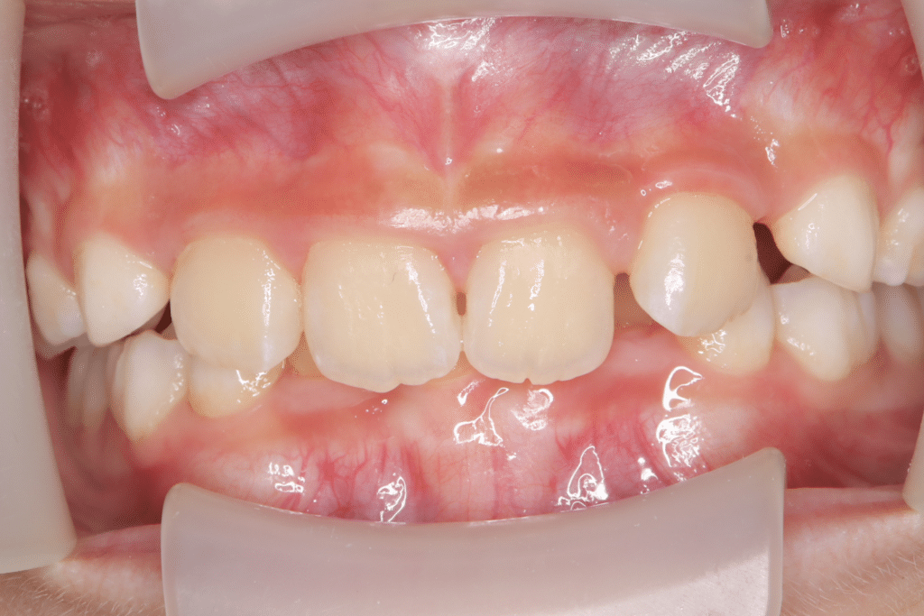 過蓋咬合(9歳5ヶ月)開始後3ヶ月