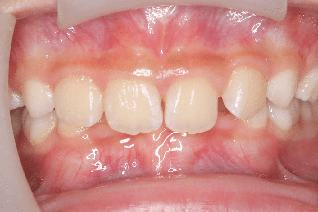 過蓋咬合(9歳6ヶ月)開始後4ヶ月