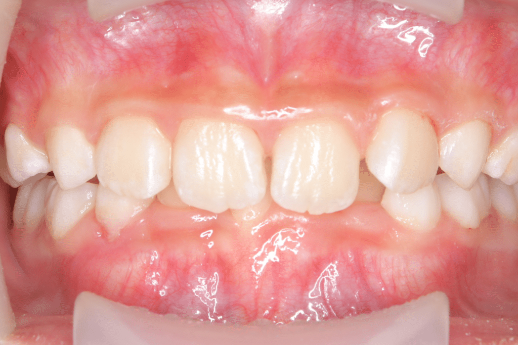 過蓋咬合(9歳7ヶ月)開始後5ヶ月