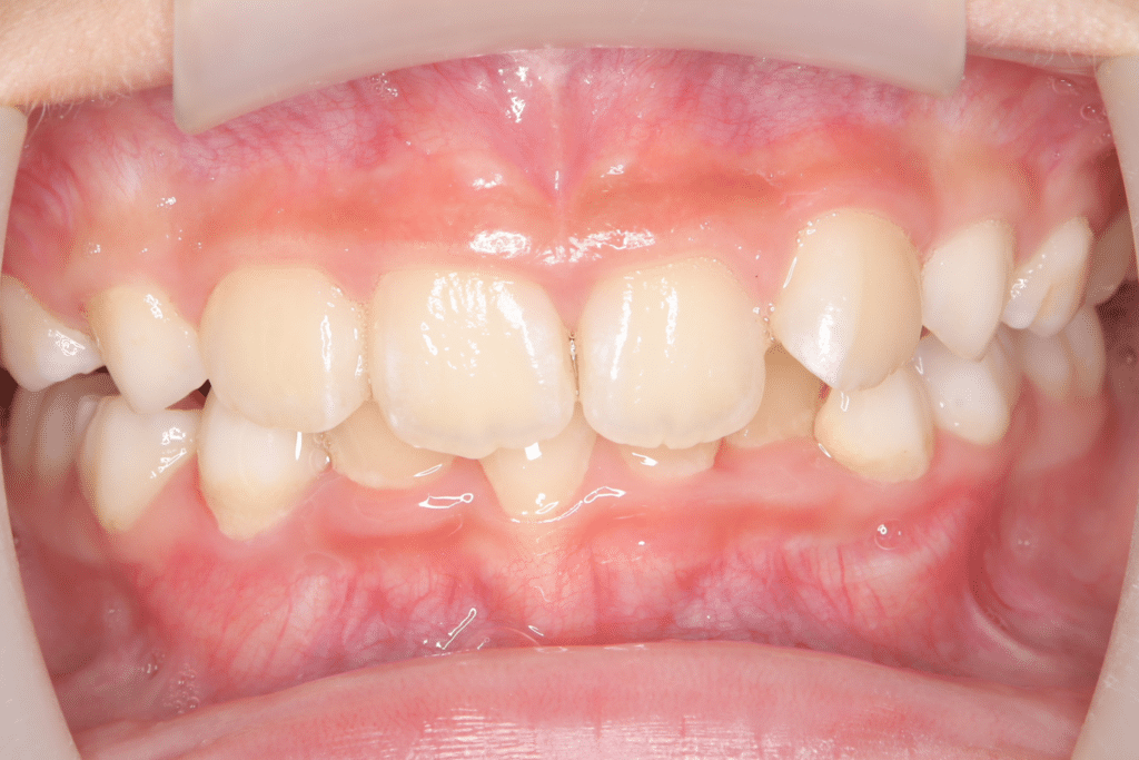 過蓋咬合(9歳9ヶ月)開始後7ヶ月