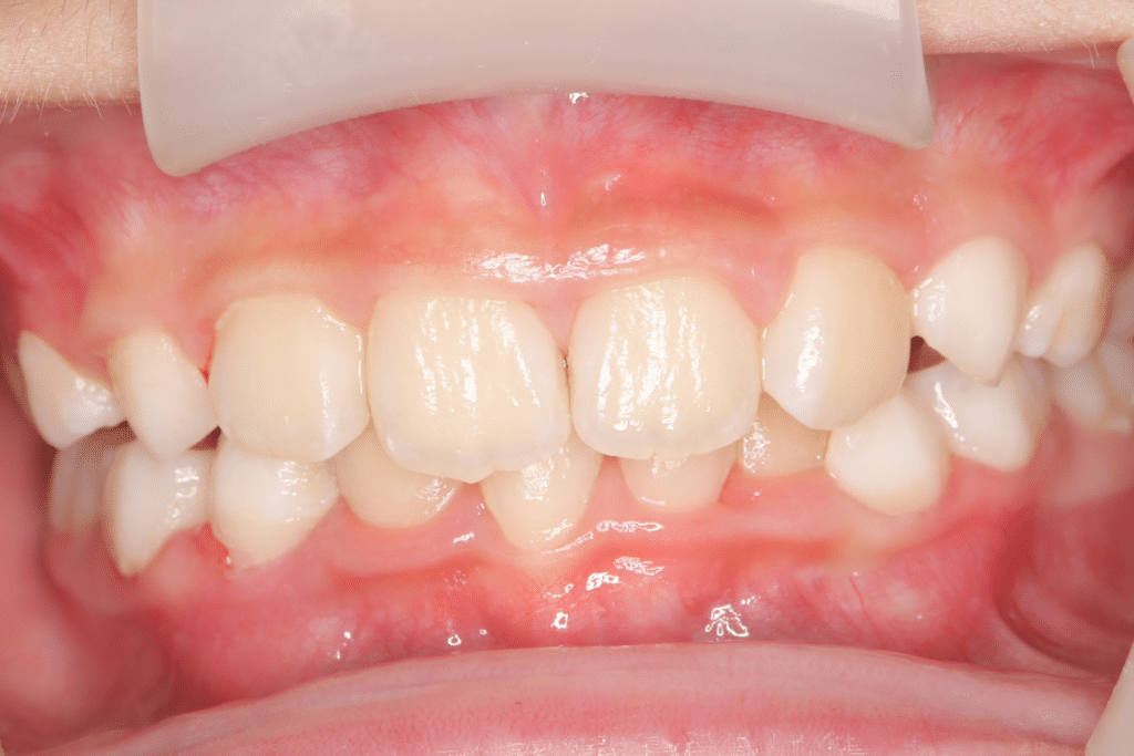 過蓋咬合(9歳10ヶ月)開始後8ヶ月