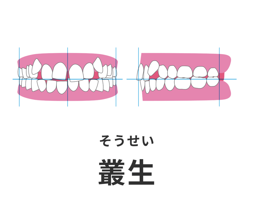 叢生_乱杭_デコボコ_症例集_矯正_小児矯正