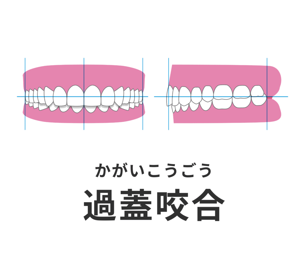 過蓋咬合_ディープバイト_症例集_矯正_小児矯正
