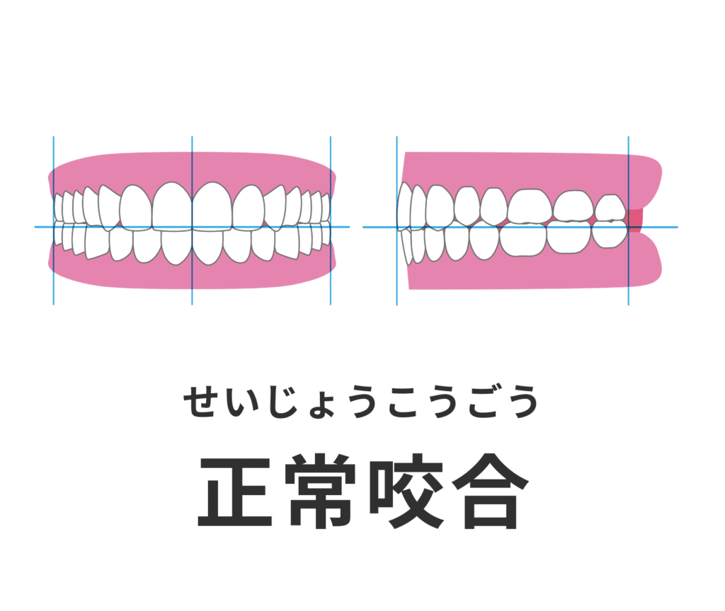 正常咬合_症例集_矯正_小児矯正