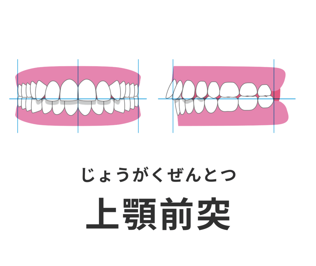 上顎前突_出っ歯_症例集_矯正_小児矯正