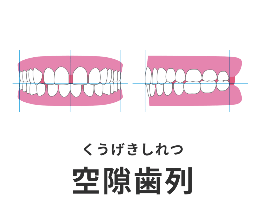 空隙歯列_症例集_矯正_小児矯正