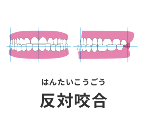 反対咬合_受け口_しゃくれ_症例集_矯正_小児矯正