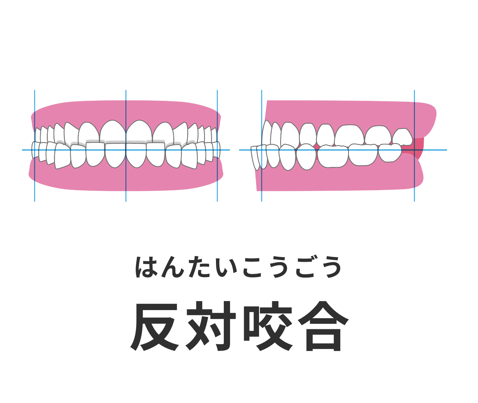 反対咬合_受け口_しゃくれ_矯正_小児矯正