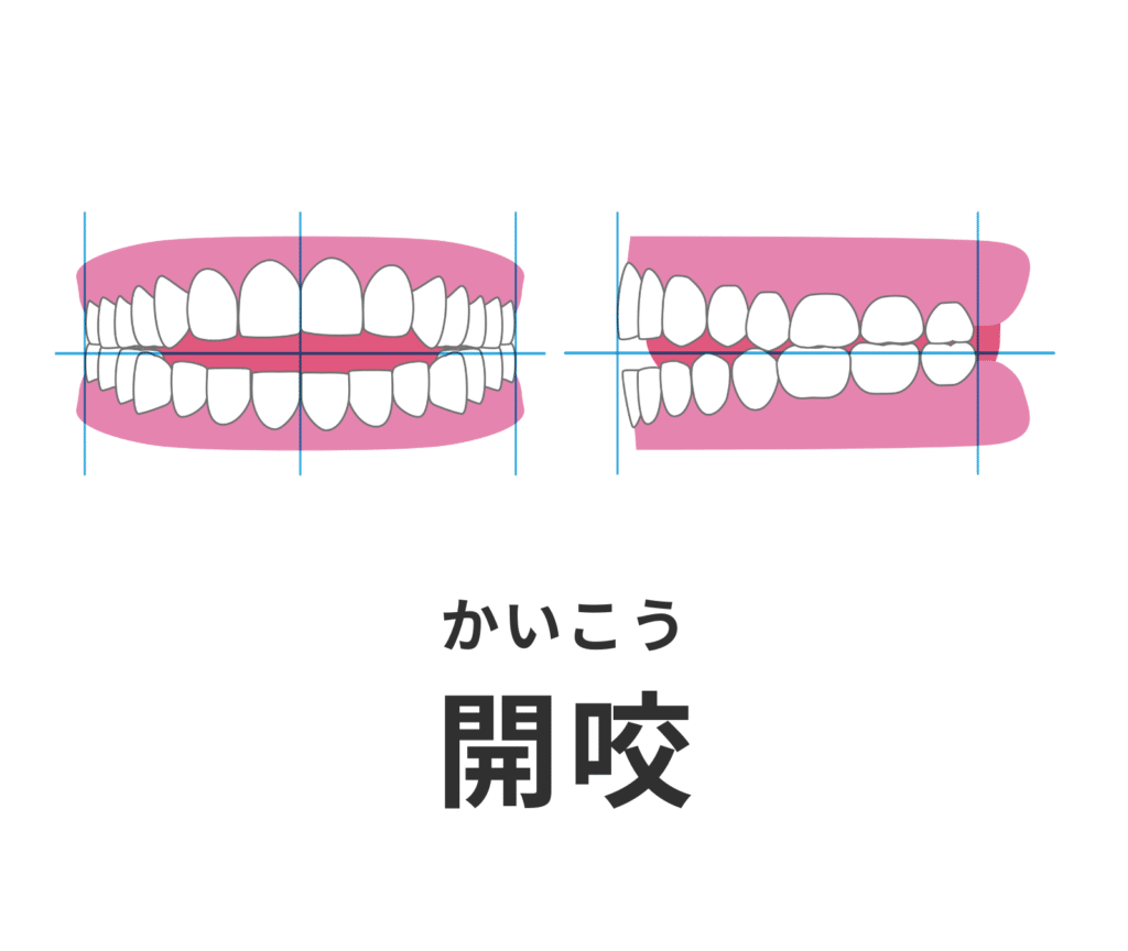 開咬_オープンバイト_症例集_矯正_小児矯正