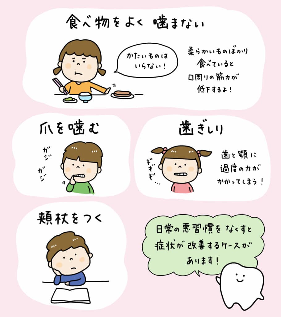 子供の反対咬合(受け口)を割り箸で治すのは危険_4_小児の反対咬合の治療に関する画像