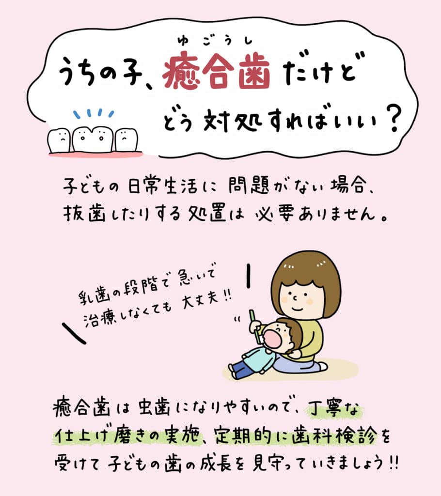 歯科検診で癒合歯と診断されたら?_6_子供の歯の癒合歯について解説するイラスト