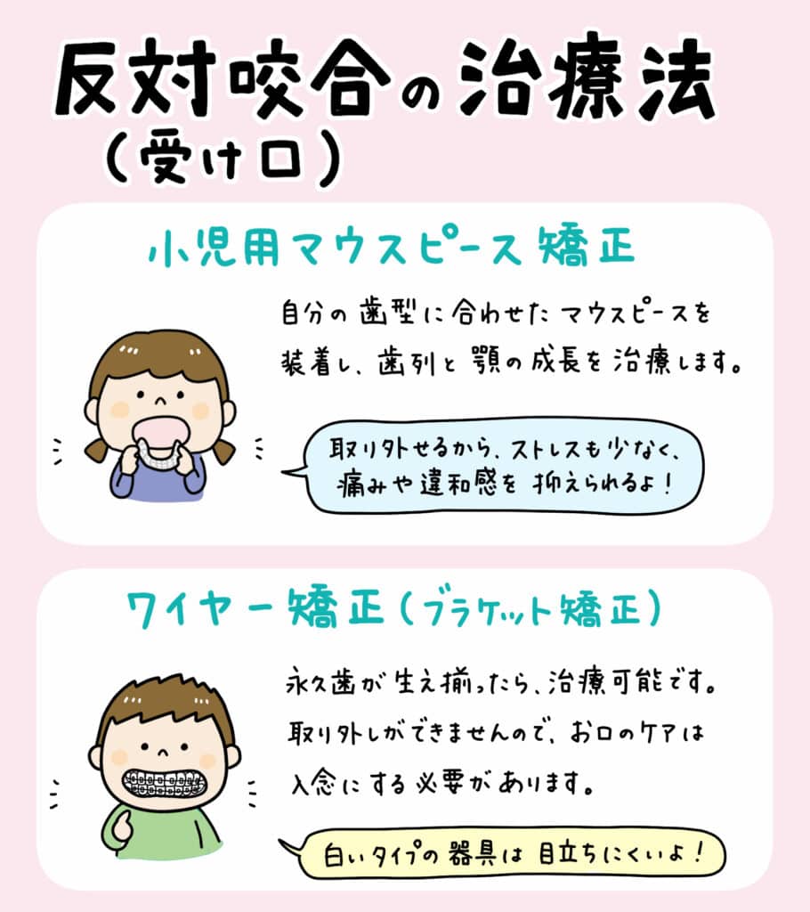 子供の反対咬合(受け口)を割り箸で治すのは危険_5_小児の反対咬合の治療に関する画像