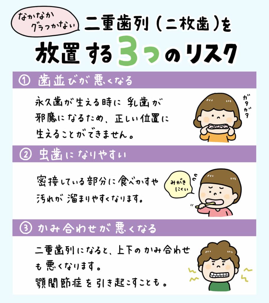 子供の二重歯列（二枚歯）とは？_4_子供の二重歯列（二枚歯）の状態とその治療法についての詳細なイラスト解説