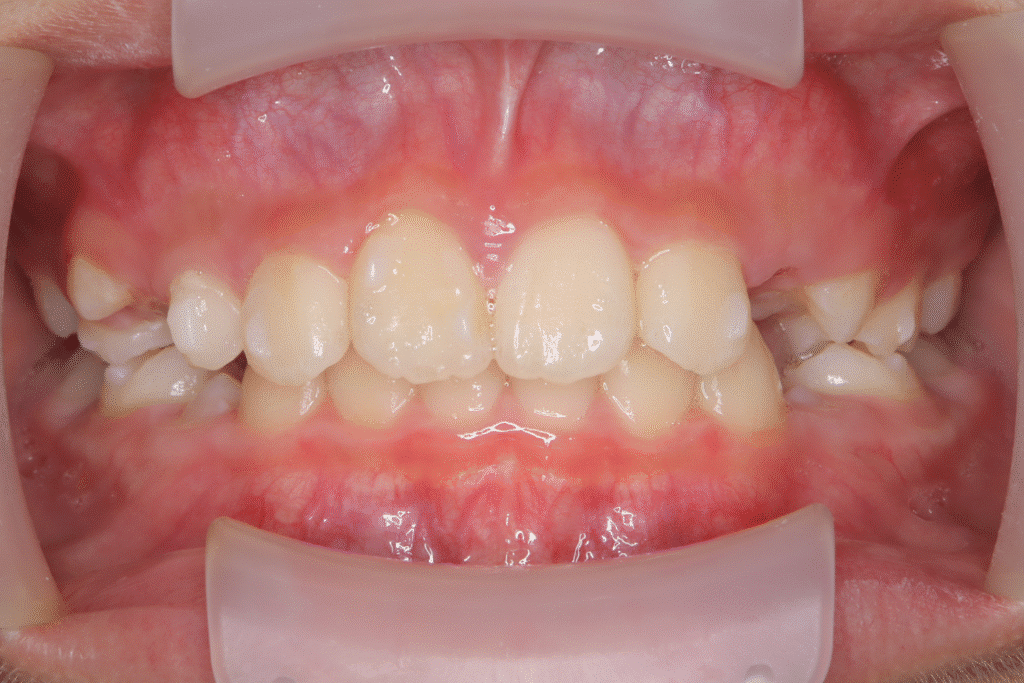 上顎前突(10歳7ヶ月)開始後0ヶ月