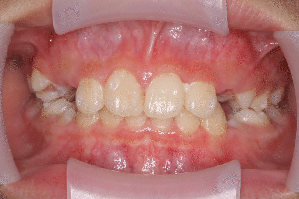 上顎前突(10歳8ヶ月)開始後0ヶ月