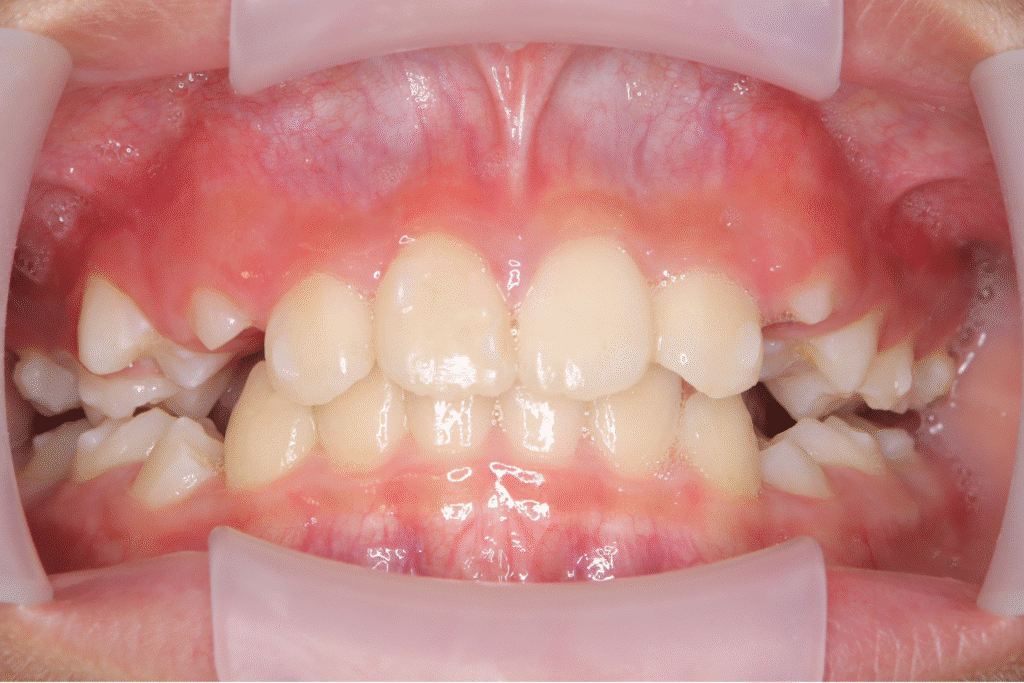 上顎前突(10歳11ヶ月)開始後3ヶ月