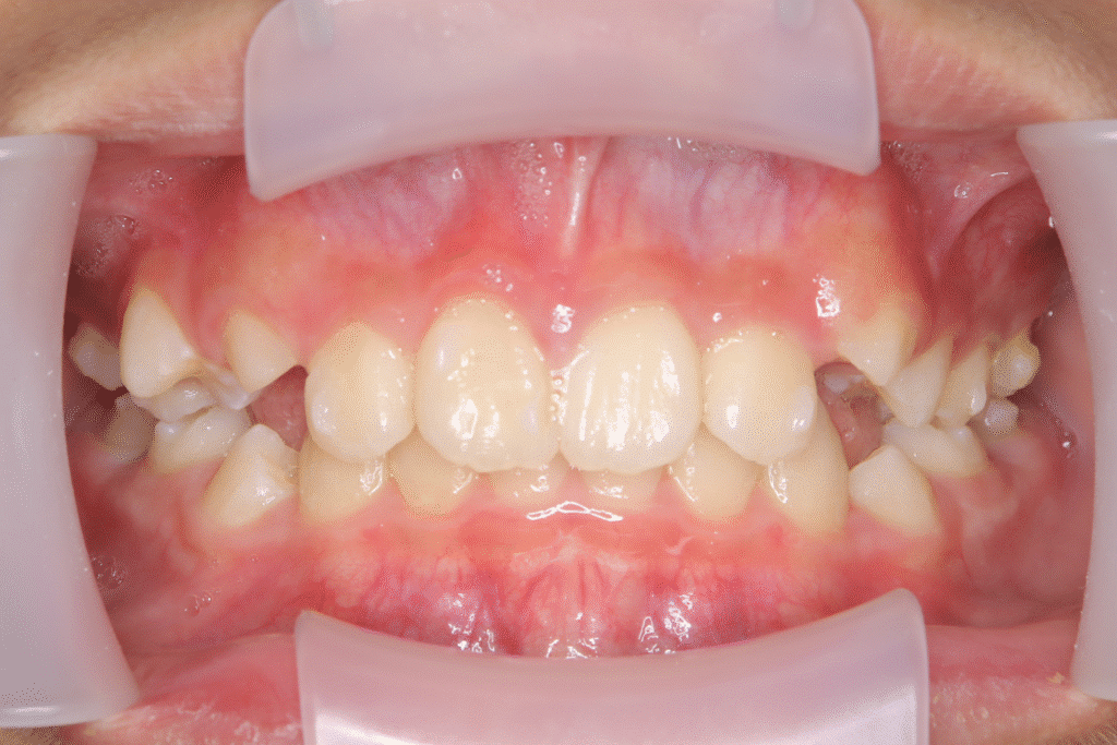 上顎前突(11歳0ヶ月)開始後5ヶ月
