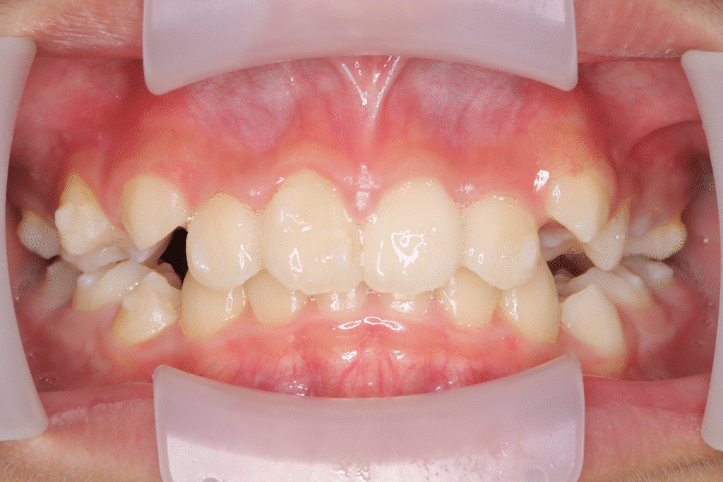 上顎前突(11歳2ヶ月)開始後6ヶ月