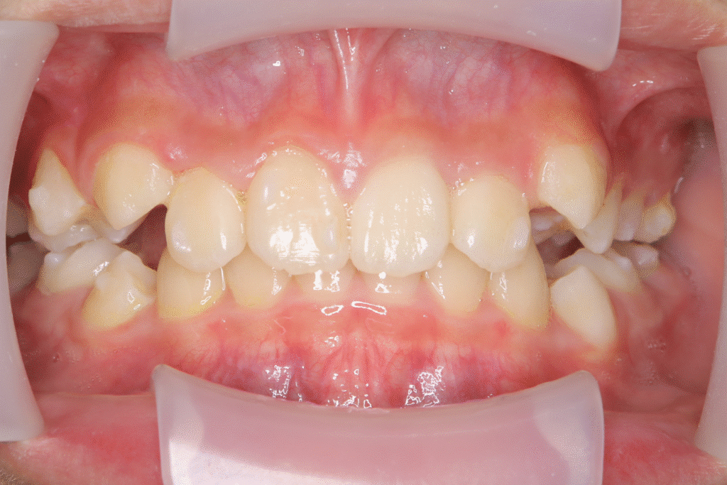 上顎前突(11歳3ヶ月)開始後8ヶ月