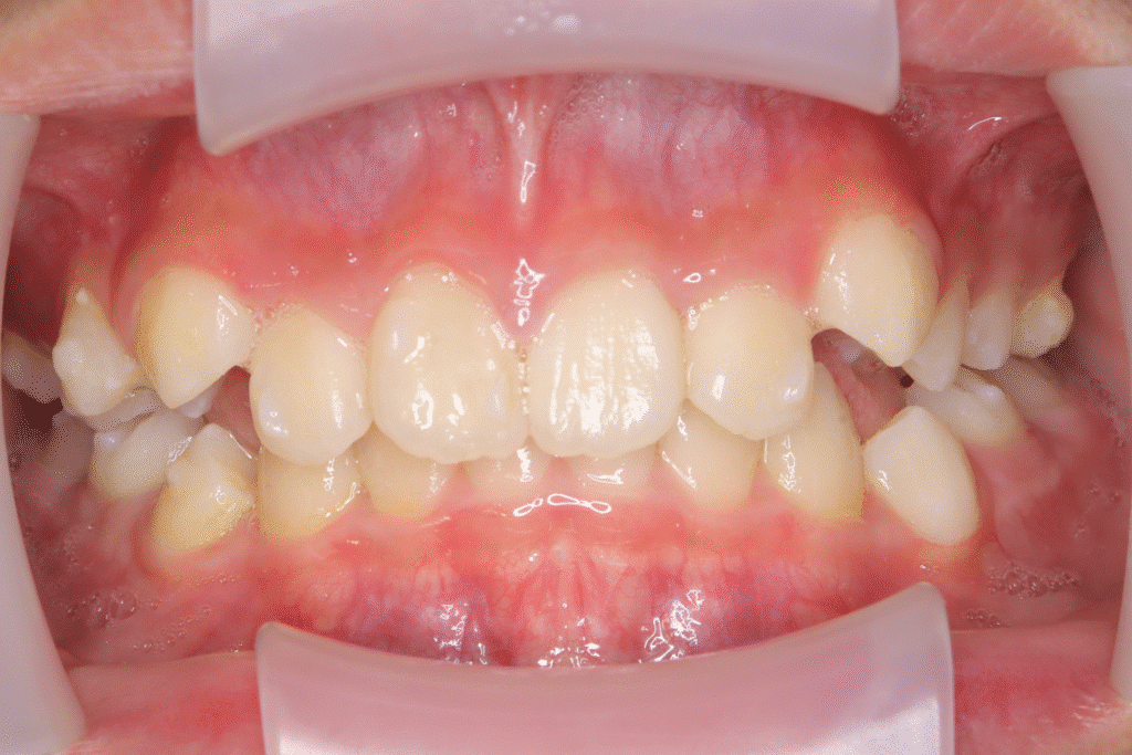 上顎前突(11歳4ヶ月)開始後9ヶ月