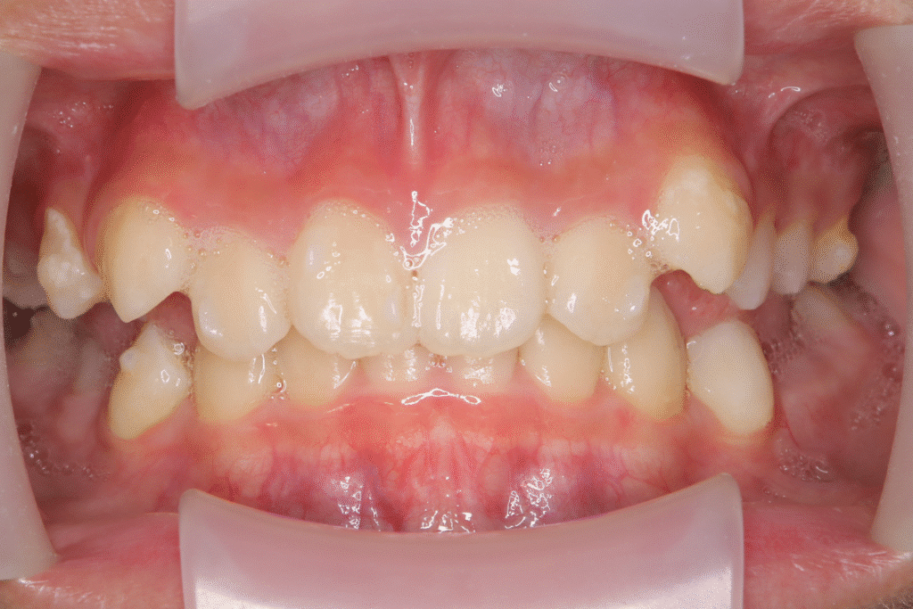 上顎前突(11歳7ヶ月)開始後11ヶ月