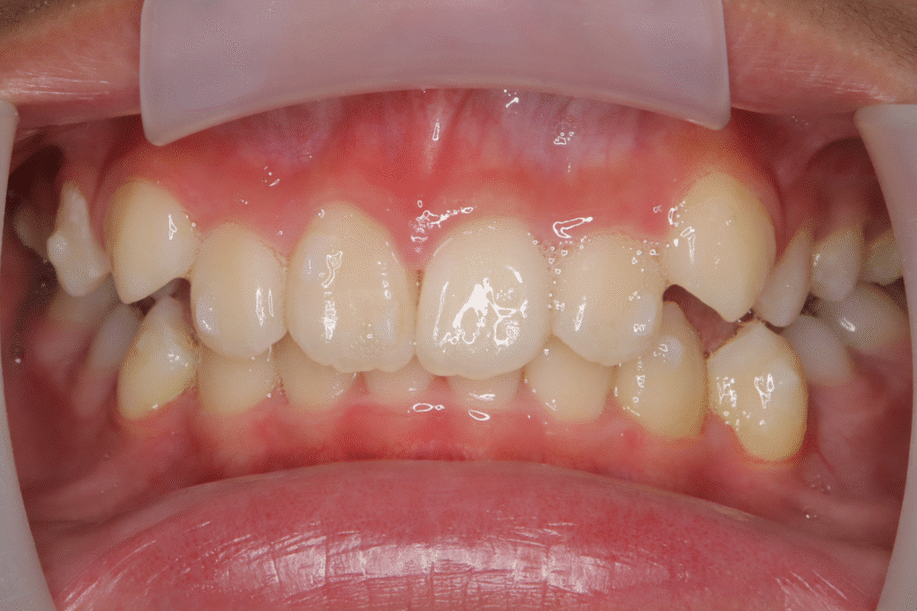 上顎前突(11歳8ヶ月)開始後12ヶ月