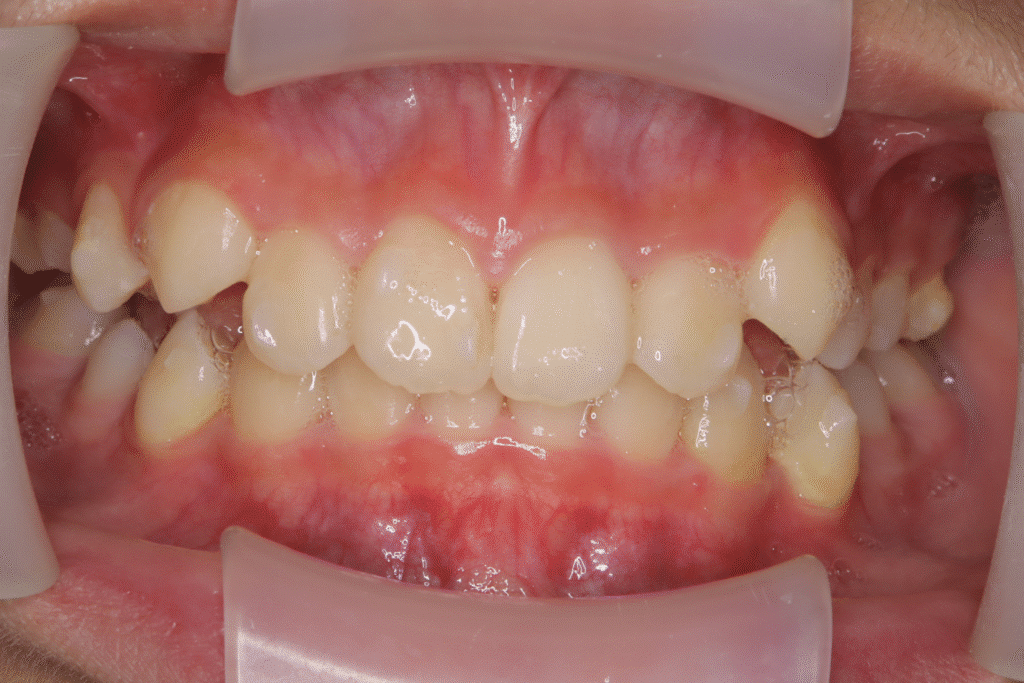 上顎前突(11歳9ヶ月)開始後14ヶ月
