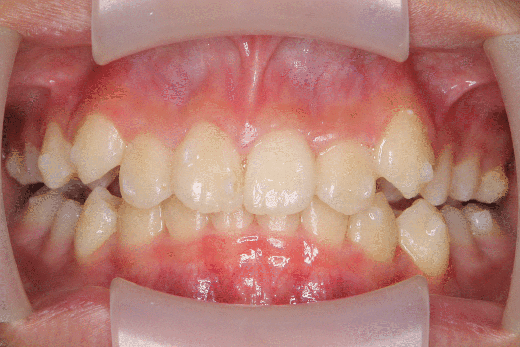 上顎前突(12歳0ヶ月)開始後16ヶ月